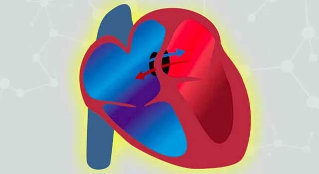 Congenital heart defect likes ASD,VSD, PDA,TOF