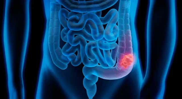 Gastro-intestinal Cancer