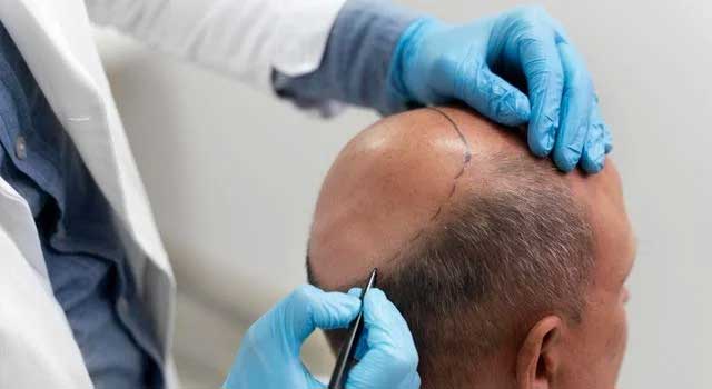 Hair Transplant