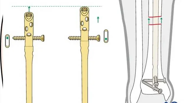 Distal femur fractures – Retrograde nailing and traditional Plating —  OrthopaedicPrinciples.com
