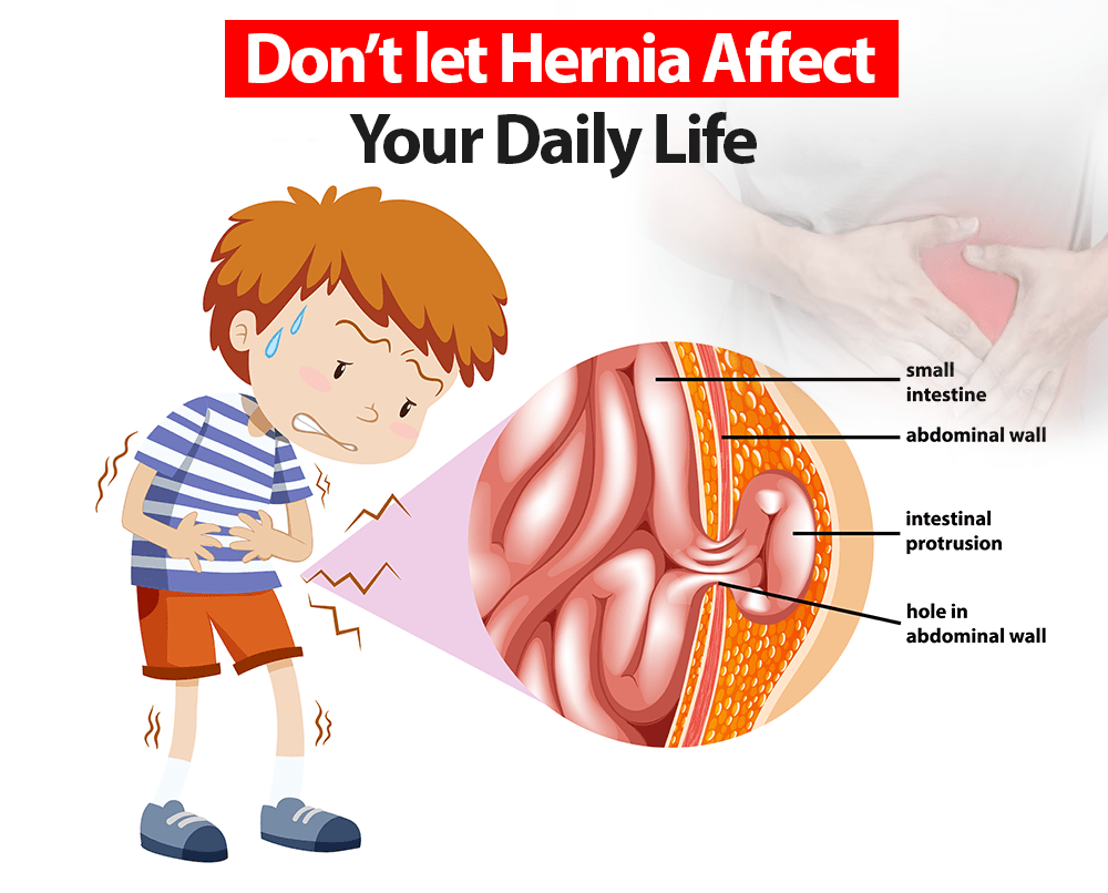 Hernia Symptoms Types