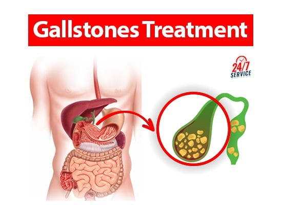 Gallstones treatment Chandigarh