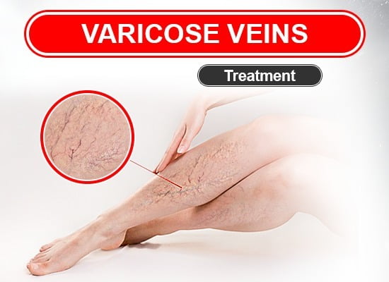 Varicose Veins Treatment in Chandigarh