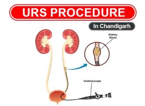 Picture of Ureteroscopy for Kidney Stone - Mukat Hospital
