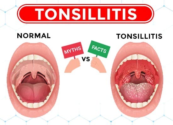Tonsillitis Myths vs. Facts